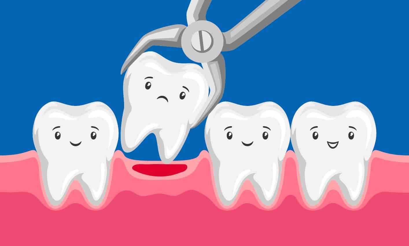 Tooth Extraction Alfano Oral And Maxillofacial Surgery